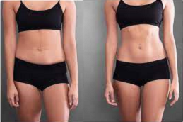 Before and after Body Contouring in Dubai