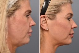 Before and after Double chin removal in Dubai
