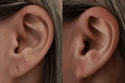 Before and after Earlobe Surgery in Dubai