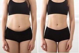 Body Contouring Dubai Before and after