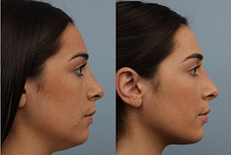 Double chin removal Dubai before and after