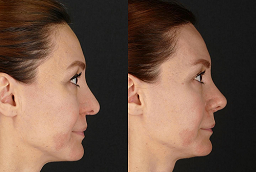 Double chin removal in Dubai before and after