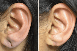 Earlobe Surgery Dubai Before and after