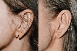 Earlobe Surgery before and after