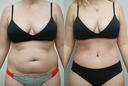 Liposuction Dubai before and after
