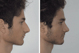 Septoplasty in Dubai before and after