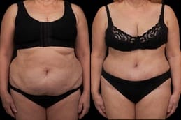 Before & After Liposuction in Dubai