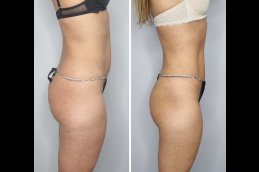 Before and after Body Lift in Dubai
