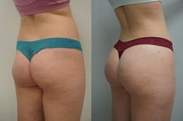 Before and after Brazilian Butt Lift in Dubai