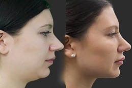 Before and after Kybella Treatment for Double Chin in Dubai