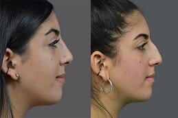 Before and after Rhinoplasty in Dubai