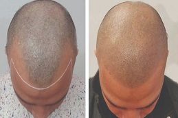 Before and after Scalp Micropigmentation in Dubai