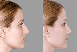 Before and after Septoplasty Dubai