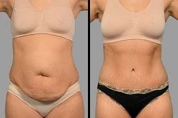 Before and after Tummy Tuck Dubai