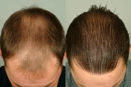Before and after hair transplant
