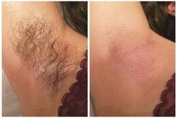 Before and after laser hair removal in Dubai