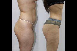 Body Lift Dubai Before and after