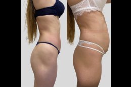 Body Lift in Dubai Before and after