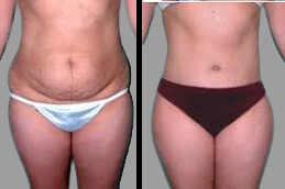 Body contouring Dubai before and after