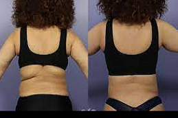 Bra Line Lift Dubai before and after