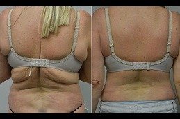 Bra Line Lift in Dubai before and after