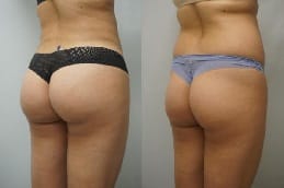 Brazilian Butt Lift Dubai before and after