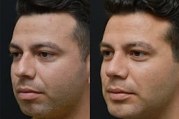 Buccal Fat Removal before & after