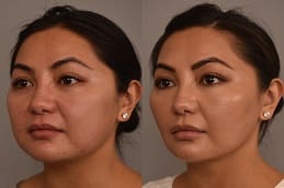Buccal Fat Removal before and after