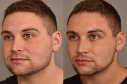 Buccal Fat Removal in Dubai before & after