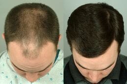 Hair transplant Dubai Before and