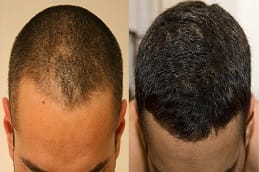 Hair transplant in Dubai before and after