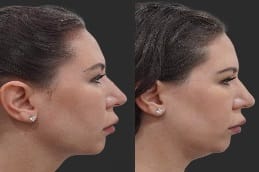 Kybella Treatment for Double Chin Dubai before and after