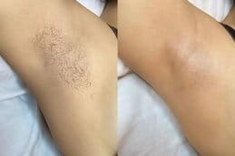 Laser hair removal dubai before and after