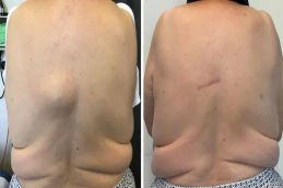 Lipoma treatment in Dubai before and after