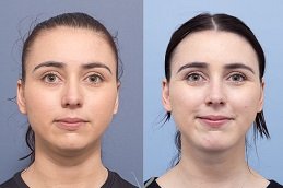 Neck lift before and after