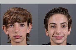 Otoplasty in Dubai Before and after