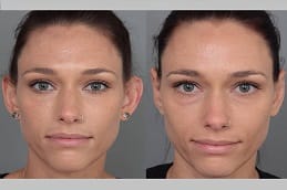 Otoplasty in Dubai beffore and after