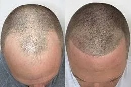 Scalp Micropigmentation Dubai Before and after