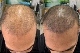 Scalp Micropigmentation in Dubai before and after