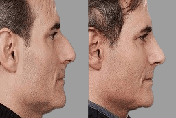 Septoplasty Dubai before and after