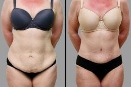 Tummy Tuck in Dubai before and after