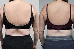 before and after Bra Line Lift in Dubai