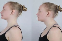before and after Buffalo Hump removal in Dubai