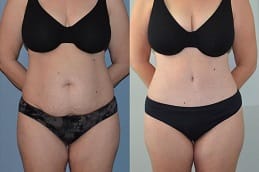 before and after Tummy Tuck in Dubai