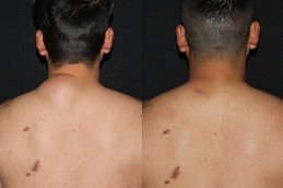 before and after lipoma treatment in Dubai