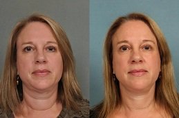 before and after neck lift dubai