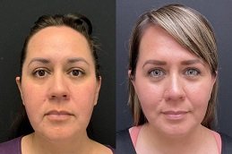 before and after neck lift