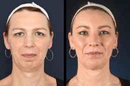 forehead lift Dubai before and after
