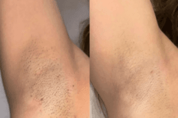 laser hair removal in Dubai before and after