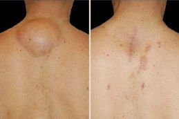lipoma treatment Dubai before and after